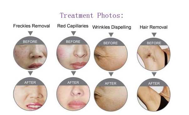 Best Beauty Salon Spa Multifunctional Laser Skin Care SHR IPL Hair Removal Machines