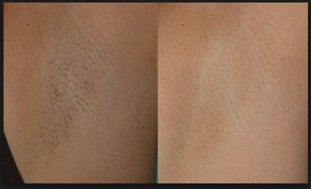 808 Laser Diode Hair Removal Beauty Device Low Price