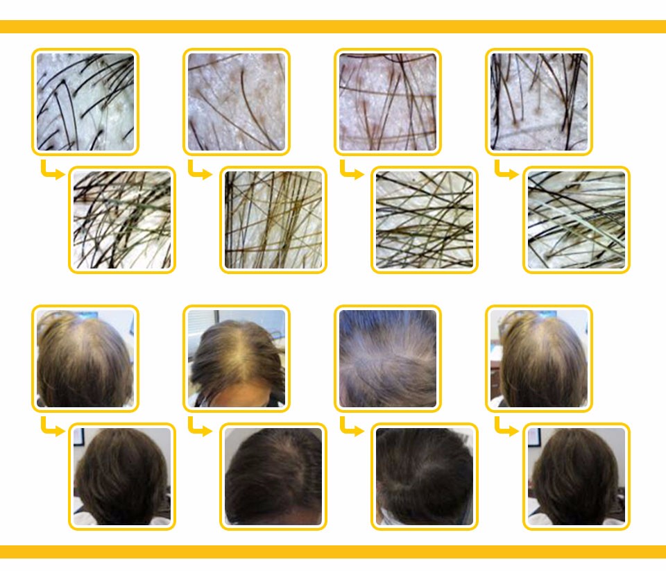 Newest Laser Hair Regrowth Machine Newest Laser Hair Regrowth Machine