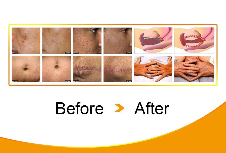 Co2 Fractional Laser Machine Scars Removal & Acne Treatment Co2 Fractional Laser Machine Scars Removal & Acne Treatment